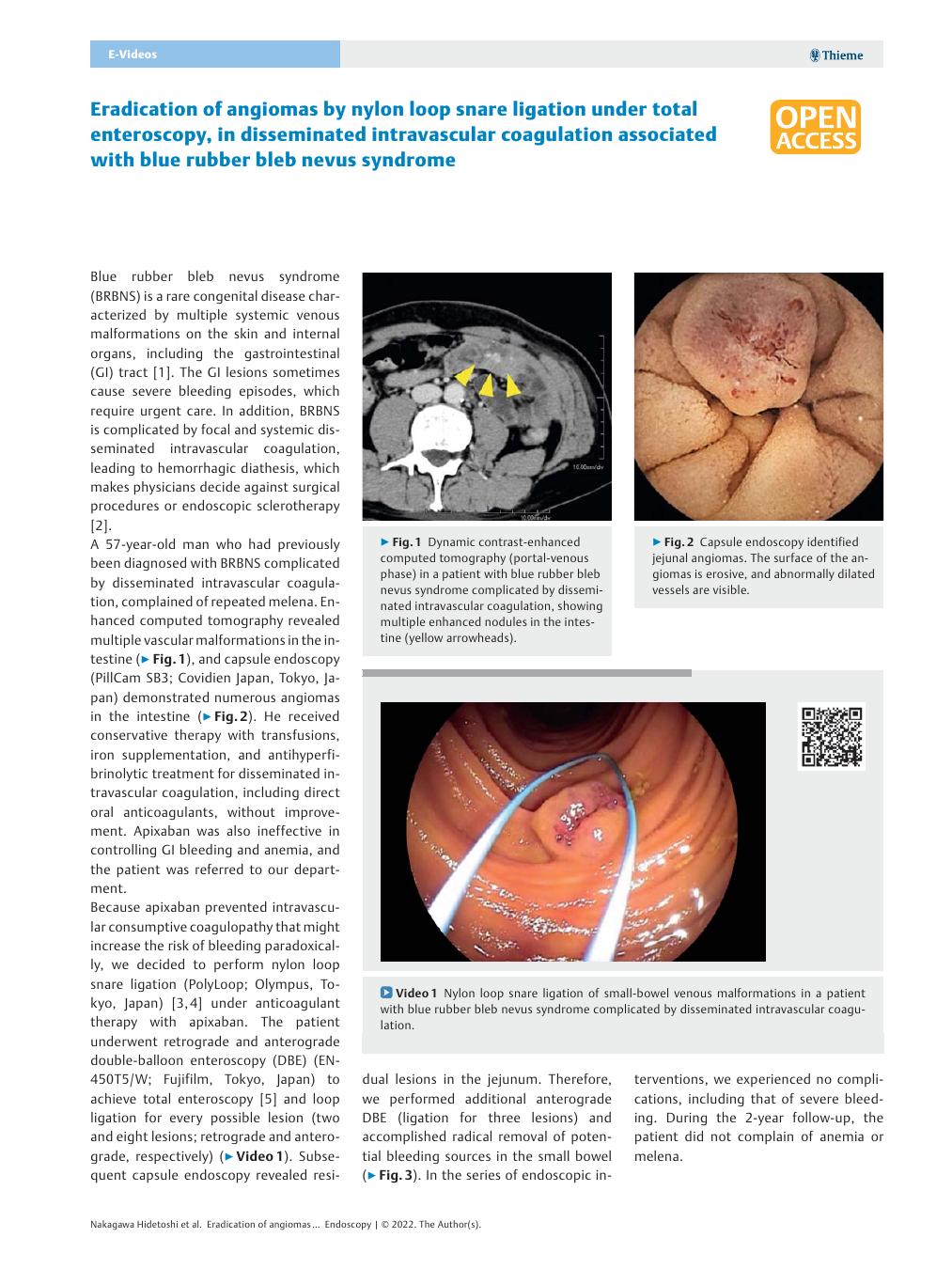 【症例報告】中河秀俊医師の症例報告がEndoscopy誌に掲載されました。